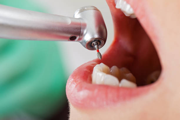 Best Emergency Tooth Extraction in Fredericksburg, PA